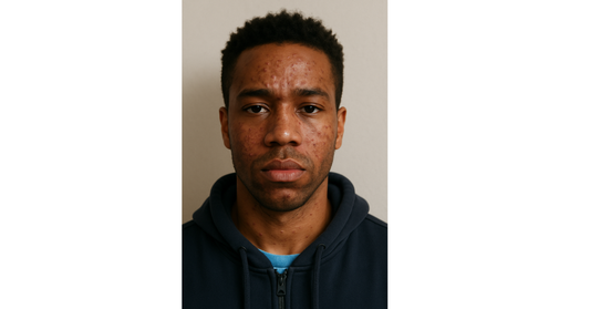 Homme nettoyant ses pores pour éliminer boutons et points noirs